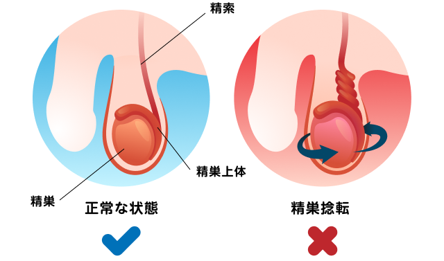 精巣捻転」とはどのような病気ですか？ ｜精巣捻転